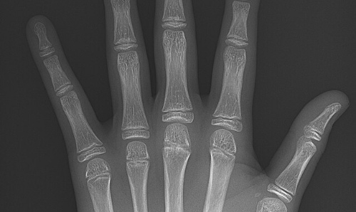X ray of a human hand.
